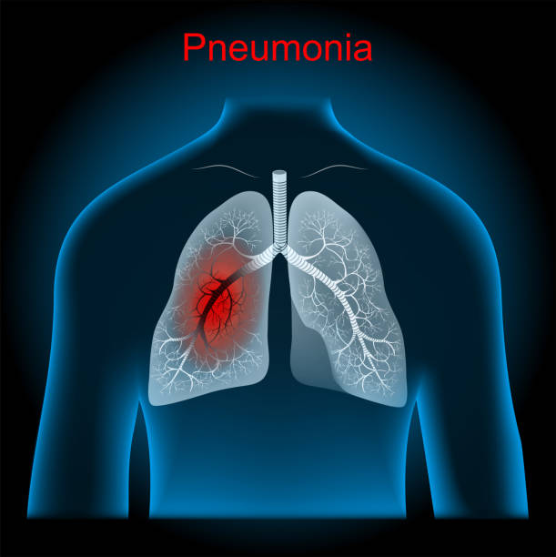 ilustraciones, imágenes clip art, dibujos animados e iconos de stock de neumonía. pulmones, bronquios y tráquea en rayos x - neumonía