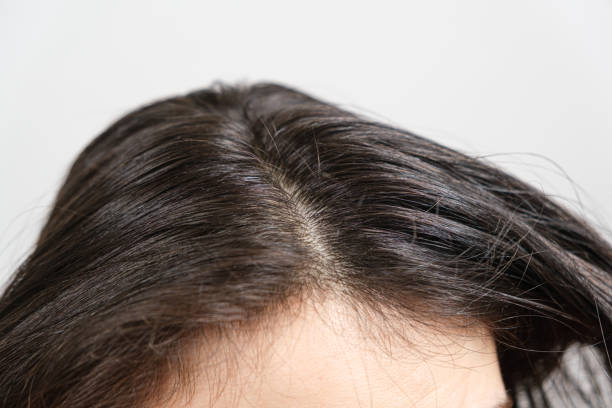 istock Dirty greasy brown long hair with dandruff, close-up 1370506871