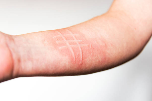 A jellyfish sting burn on a man's leg, on the beach