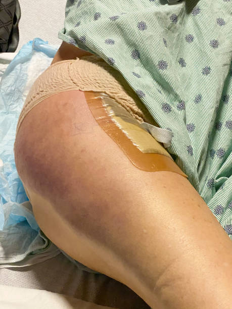 Series-Medical: Hip replacement with front incision Bandage covering the incision on the front of an unidentifiable surgery patient who has had a hip replacement. Bruising down her leg from the surgery. hip replacement stock pictures, royalty-free photos & images
