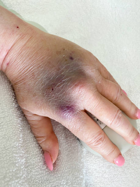 serie-medical: geschwollene hand von infiltrierter iv - iv bruise stock-fotos und bilder