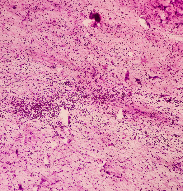 медиастинальная масса (кт-управляемая fna): микроскопическое изображение тимомы, опухоли вилочковой железы, показывают некротический матер� - тимус стоковые фото и изображения