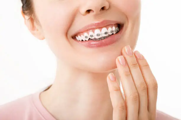 Orthodontic Treatment. Dental Care Concept. Beautiful Woman Healthy Smile close up. Closeup Ceramic and Metal Brackets on Teeth. Beautiful Female Smile with Braces.