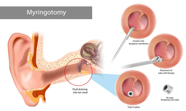 ภาพประกอบสต็อกที่เกี่ยวกับ “paracentesis หรือ myringotomy. แผลเข้าไปในเยื่อหุ้มเซลล์ tympanic ขั้นตอนการผ่าตัดที่เกี่ยวข้องกับการเจาะของเย - puncturing”