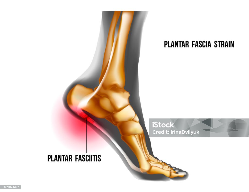 Plantar fasciitis inflammation and ruptures strain. Foot pain, realistic anatomy illustration Plantar fasciitis inflammation and ruptures strain. Bones ot Foot pain realistic illustration. Medial view. Anatomy of joints, human leg black and yellow transparente skeleton. For medical orthopedic advertising. Vector illustration stock vector. Plantar Fasciitis stock vector
