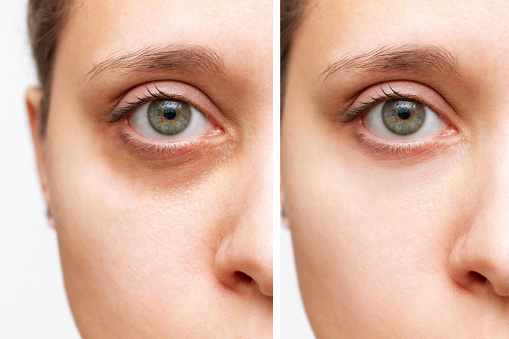 Cropped shot of a young caucasian woman's face with dark circles under eye before and after cosmetic treatment isolated on a white background. Bruise under the eyes caused by fatigue, insomnia