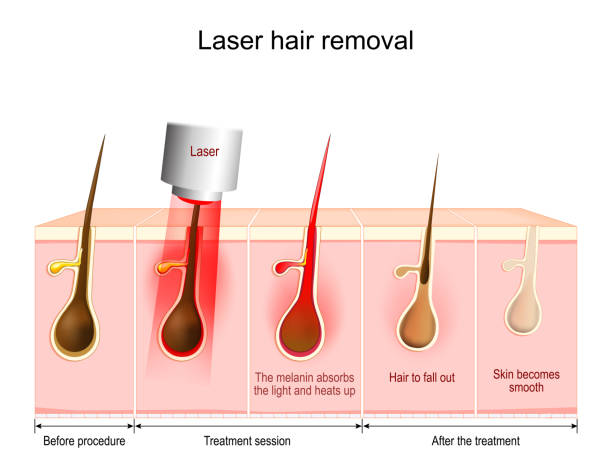 laser-haarentfernung - laserlicht stock-grafiken, -clipart, -cartoons und -symbole