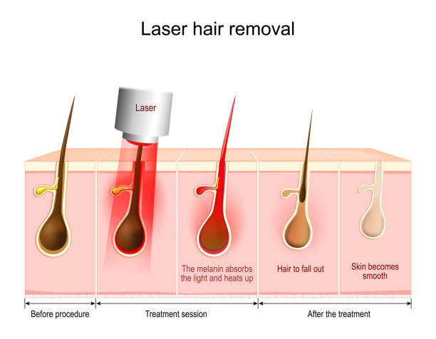 Laser hair removal Laser hair removal. The melanin absorbs the light and heats up, Hair to fall out. Vector diagram about skin and hair condition Before procedure, After the treatment and during Treatment session. hair removal stock illustrations