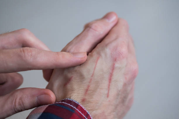 Close up view of man showing hand with cat scratches on skin Close up - man showing hand with cat scratches on skin. Pain, damaged, inflammation, injury concept skin scrape stock pictures, royalty-free photos & images
