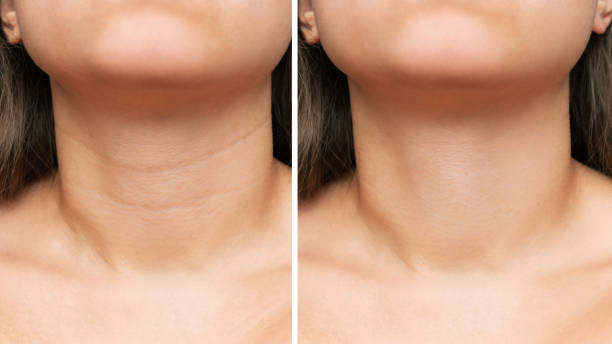 Young woman's neck with wrinkles before and after treatment. Result of cosmetic rejuvenating procedure Сlose-up of young woman's neck with wrinkles before and after treatment. Result of cosmetic rejuvenating procedures. Lines, age-related changes, Venus rings. Neck lift, collagen injections, skin care neck stock pictures, royalty-free photos & images