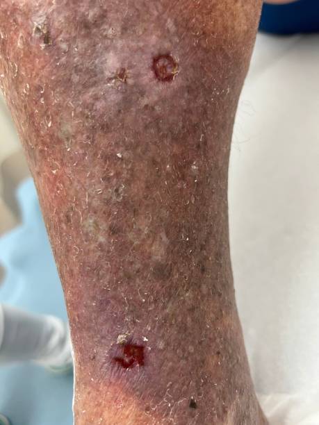 ulcère mixte sur la jambe avec insuffisance veineuse chronique et maladie artérielle périphérique et dermatite de stase - venous insufficiency photos et images de collection