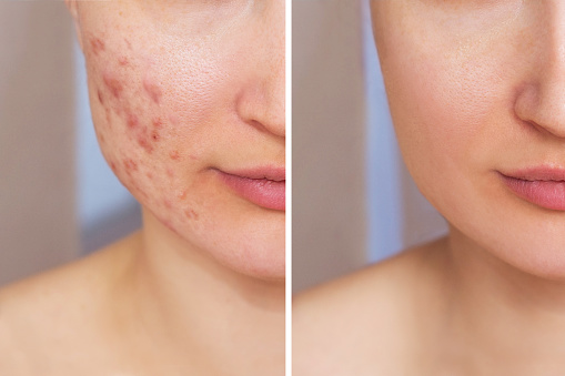 Foto recortada de la cara de una mujer joven antes y después del tratamiento del acné. Problemas en la piel, granos, cicatrices rojas photo