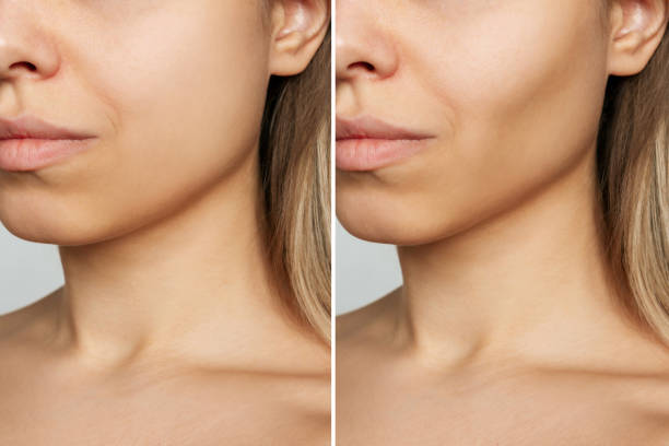 Cropped shot of young woman's face before and after plastic surgery buccal fat pad removal. Result Cropped shot of young woman's face before and after plastic surgery buccal fat pad removal. A lower part of face with clear highlighted cheekbones. Result of cosmetic surgery cheek stock pictures, royalty-free photos & images