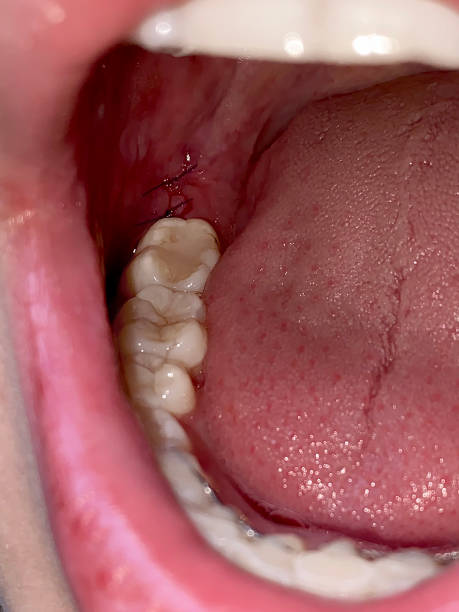 Sutures after wisdom tooth extraction, Dental surgery. - https://media.istockphoto.com/id/1371587050/photo/soft-focus-sutures-after-wisdom-tooth-extraction-dental-surgery-oral-hygiene.jpg?s=612x612&w=0&k=20&c=lu8Lyq6cFghpoXtixylzSTLE0MZIBUXnugYJAVKeRm4=