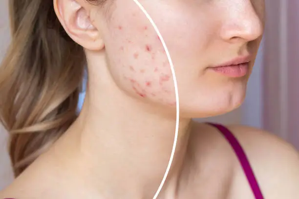 Cropped shot of a young woman's face before and after acne treatment. Pimples, red scars on the girl's cheeks. Problem skin, care and beauty concept. Dermatology, cosmetology. Result of a therapy