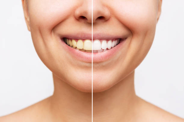 foto recortada de una joven mujer sonriente antes y después del blanqueamiento dental aislada sobre un fondo blanco - blanqueamiento dental fotografías e imágenes de stock