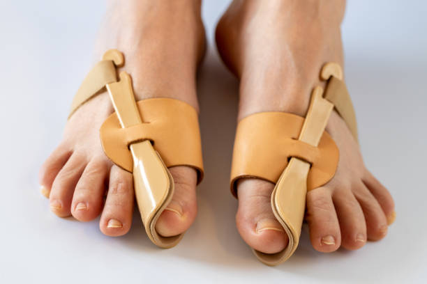 problemi ortopedici, piedi con un apparecchio correttore per l'alluce valgo, trattamento della degenerazione ossea - podiatrist chiropractor massaging human foot foto e immagini stock