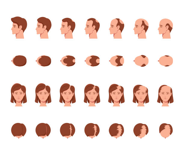 kuvapankkikuvitukset aiheesta miesten ja naisten kaljuuntumisen vaiheet. mies- ja naishahmot pää, sivu- ja etunäkymä hiustenlähtöprosessilla - receding hairline