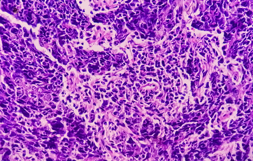 Photomicrograph of Nasopharyngeal carcinoma, nasopharynx cancer, most common cancer originating in the nasopharynx, 100x