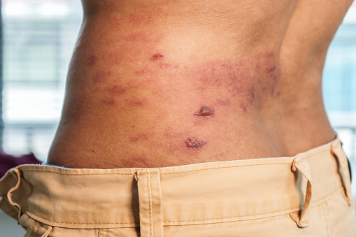 Síntoma de herpes zóster en la espalda photo
