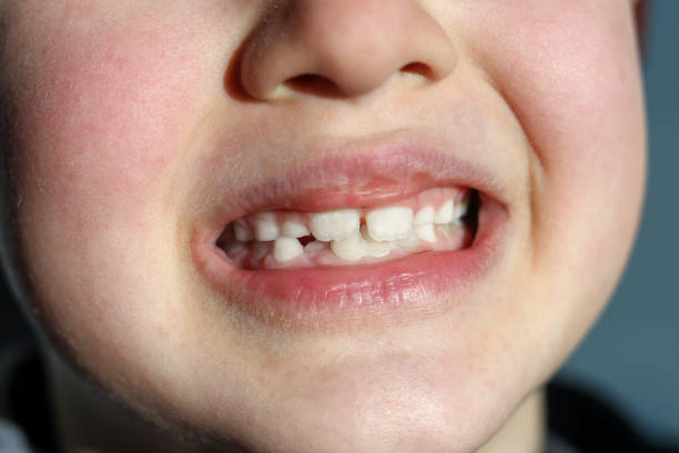 istock A Boy Smiling And Showing His New Growing Teeth. 1372021547