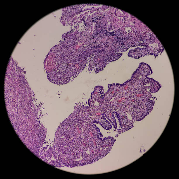 vejiga urinaria (biopsia): cistitis crónica, mucosa vesical microscópica, infiltración de células inflamatorias en la lámina propia, cistitis intersticial - interstitial fotografías e imágenes de stock