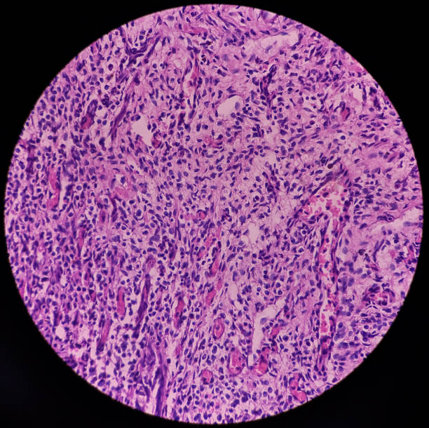 vejiga urinaria (biopsia): cistitis crónica, mucosa vesical microscópica, infiltración de células inflamatorias en la lámina propia, cistitis intersticial - interstitial fotografías e imágenes de stock