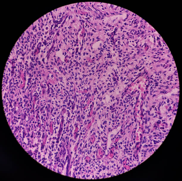 Urinary bladder(biopsy): Chronic cystitis, microscopic show bladder mucosa, infiltration of inflammatory cells in the lamina propria, interstitial cystitis Urinary bladder(biopsy): Chronic cystitis, microscopic show bladder mucosa, infiltration of inflammatory cells in the lamina propria, interstitial cystitis, no malignancy seen. lamina propria stock pictures, royalty-free photos & images