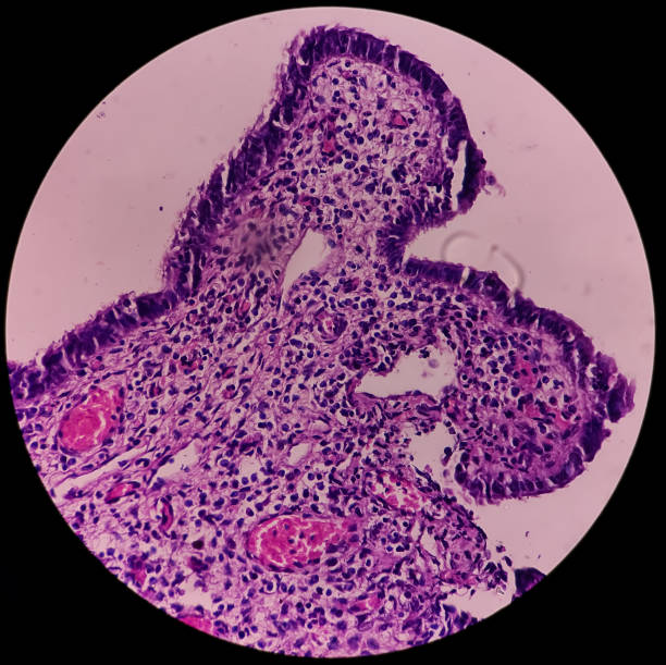 vejiga urinaria (biopsia): cistitis crónica, mucosa vesical microscópica, infiltración de células inflamatorias en la lámina propia, cistitis intersticial - interstitial fotografías e imágenes de stock