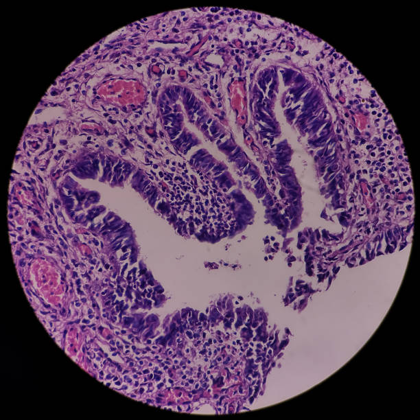 vejiga urinaria (biopsia): cistitis crónica, mucosa vesical microscópica, infiltración de células inflamatorias en la lámina propia, cistitis intersticial - interstitial fotografías e imágenes de stock