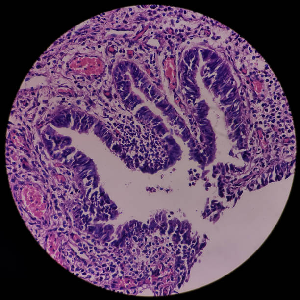 Urinary bladder(biopsy): Chronic cystitis, microscopic show bladder mucosa, infiltration of inflammatory cells in the lamina propria, interstitial cystitis Urinary bladder(biopsy): Chronic cystitis, microscopic show bladder mucosa, infiltration of inflammatory cells in the lamina propria, interstitial cystitis, no malignancy seen. lamina propria stock pictures, royalty-free photos & images