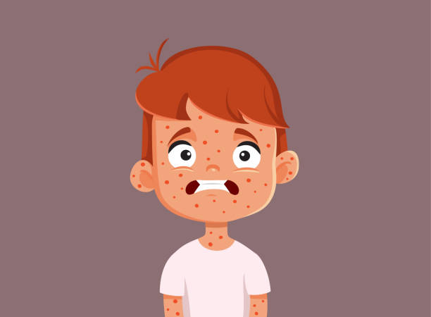 Child Suffering from Measles Vector Cartoon Illustration Little kid getting a viral disease suffering from the symptoms measles illustrations stock illustrations