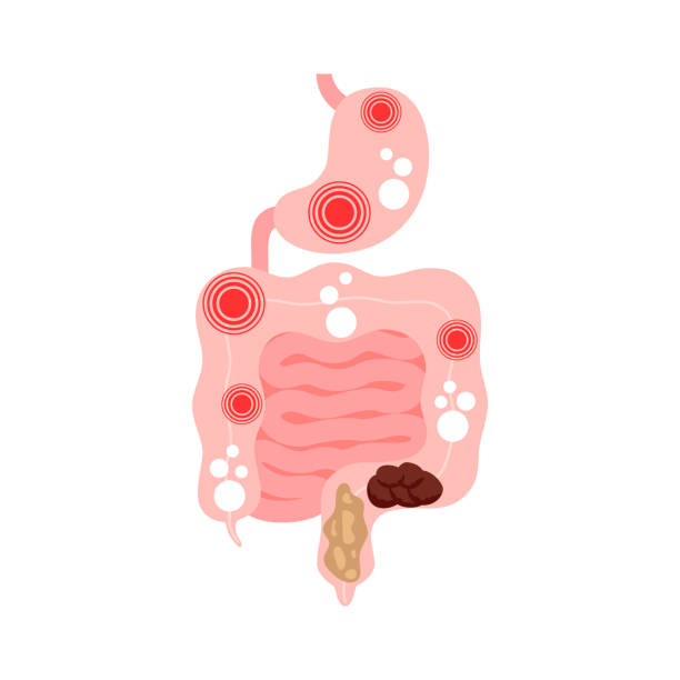 Irritable bowel syndrome, IBS. Symptoms in intestine and stomach pain, bloating, flatulence and diarrhea. Vector illustration Irritable bowel syndrome, IBS. Symptoms in intestine and stomach pain, bloating, flatulence and diarrhea. Vector rectum stock illustrations