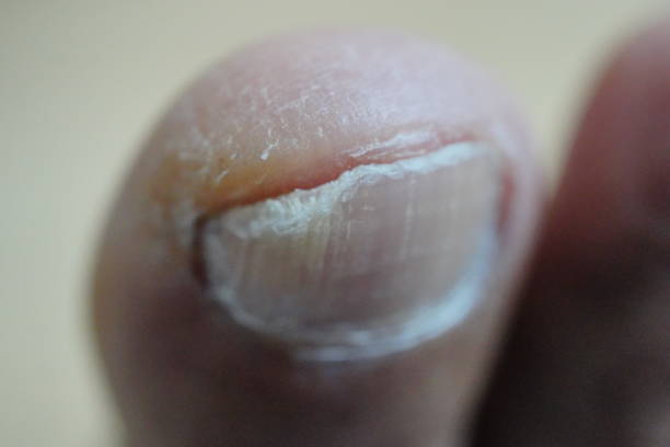 istock Fungal nail infection 1372167534