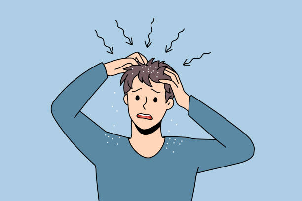Itchy head and dandruff concept vector art illustration