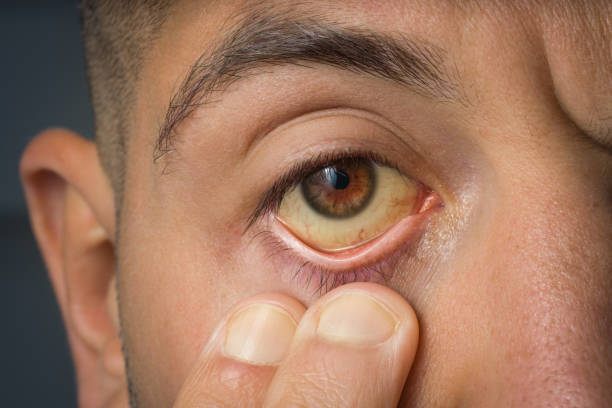 homme malade vérifiant les yeux jaunes en raison d’un taux élevé de bilirubine, d’une cirrhose ou d’une hépatite. maladie du foie, problèmes hépatiques ou jaunisse - yellowing photos et images de collection