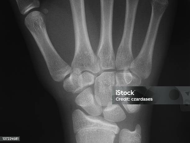 Foto de Punho De Raios X e mais fotos de stock de Acidente - Acidente, Anatomia, Caixa de Luz