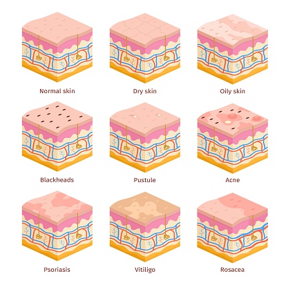 3d human skin types cross section layers. Dry, oily and normal epidermis. Skin problems, acne, blackheads, psoriasis and vitiligo vector set. Illustration of medical dermatology epidermis