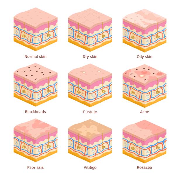 3d human skin types cross section layers. Dry, oily and normal epidermis. Skin problems, acne, blackheads, psoriasis and vitiligo vector set 3d human skin types cross section layers. Dry, oily and normal epidermis. Skin problems, acne, blackheads, psoriasis and vitiligo vector set. Illustration of medical dermatology epidermis dry skin stock illustrations