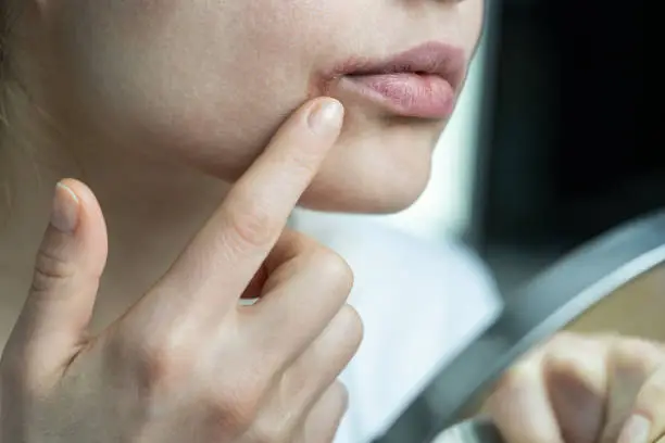 Woman applying lip balm with finger to prevent dryness and chapping in cold winter season, looking at mirror. Female dry lips affected by herpes, suffering from food allergy, infection or virus.