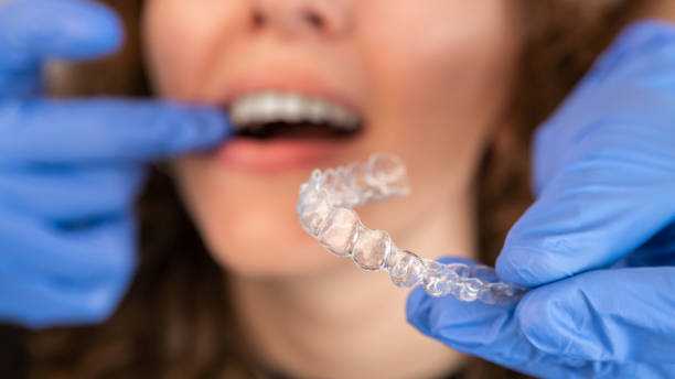 kieferorthopäde, der unsichtbare transparente zahnspangen aus silikon auf die zähne der frau legt - zahnschiene stock-fotos und bilder