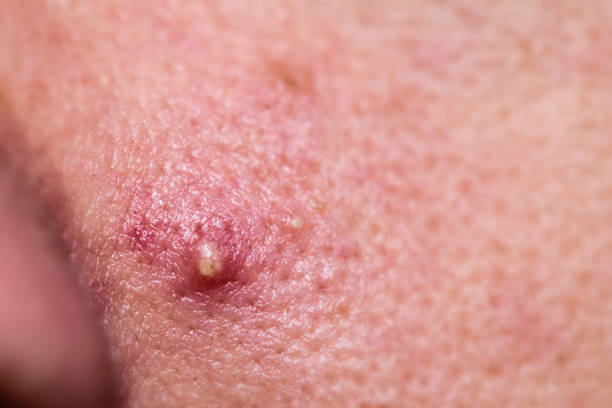 istock Pimple on Cheek of a Young Man 1372509331