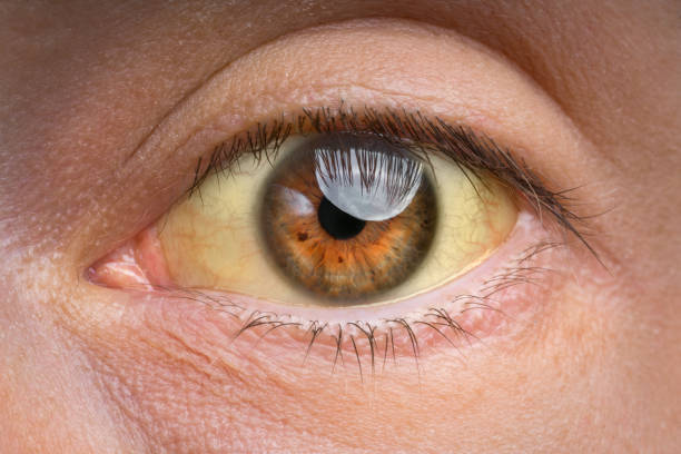 Closeup of yellow eye because of high bilirubin level, cirrhosis or hepatitis. Liver disease, liver problems or jaundice Closeup of yellow eye because of high bilirubin level, cirrhosis or hepatitis. Liver disease, liver problems or jaundice. High quality photo liver failure stock pictures, royalty-free photos & images