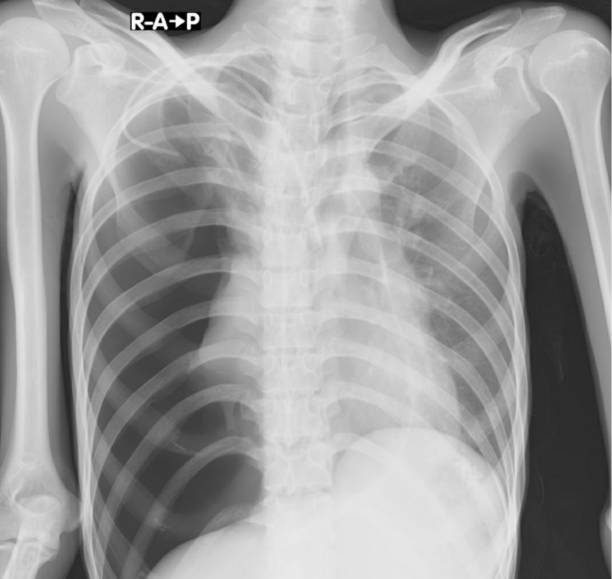 istock Pneumothorax chest x ray 1372747037