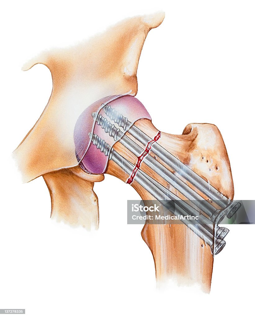 ヒップ骨折の修理 - 大腿骨のロイヤリティフリーストックイラストレーション