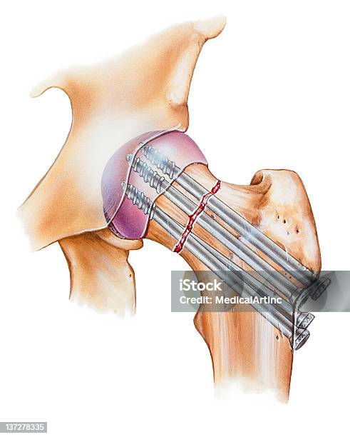 ヒップ骨折の修理 - 大腿骨のベクターアート素材や画像を多数ご用意 - 大腿骨, 写真, 縦位置