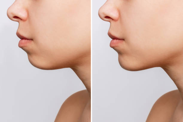 Chin reduction. Cropped shot of woman's face in profile with chin before and after mentoplasty Сhin reduction. Cropped shot of woman's face with chin before and after mentoplasty isolated on a gray background. The result of cosmetic plastic surgery. Profile. Beauty concept chin stock pictures, royalty-free photos & images