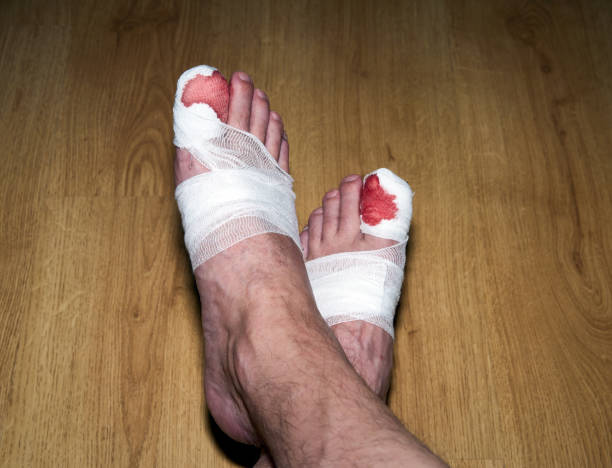 istock A blood bandaged big toe 1372812080