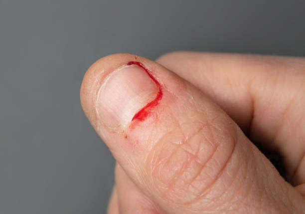 Bloody thumb from nail biting. Close up of adult female hand with fresh chewed fingernail and small wounds on the surrounding skin. Signs of mental stress or chronic onychophagia. Selective focus. bed of nails stock pictures, royalty-free photos & images