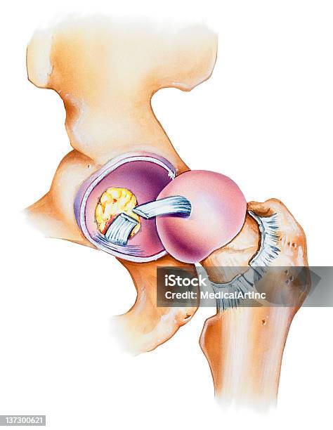 Hip Joint Opened Lateral View Stock Illustration - Download Image Now - Hip - Body Part, Articular Cartilage, Acetabulum